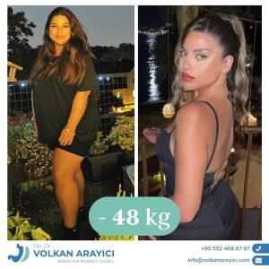 was-kostet-eine-magenverkleinerung